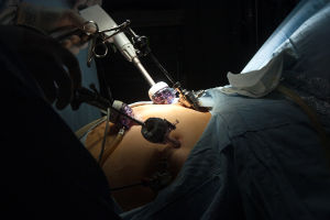 Chirurgie de l'obésité: bypass gastrique